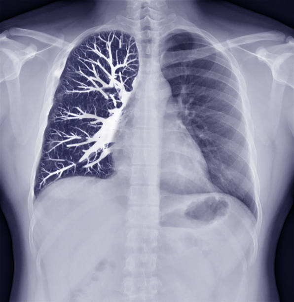 An image show pleural effusion and take treatment at Santosh, homeo Hall and Clinic
