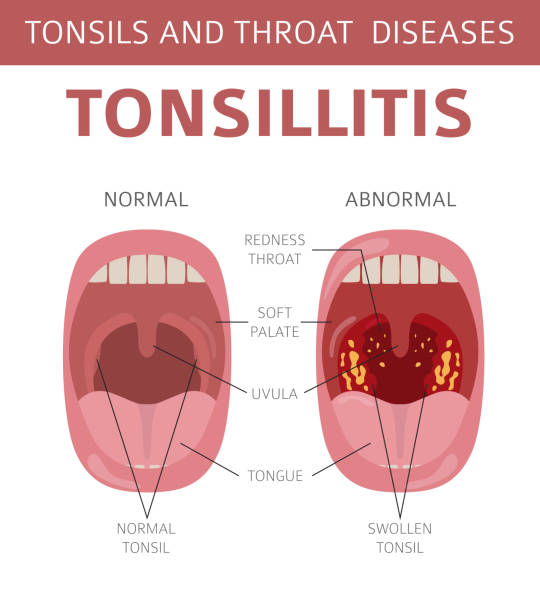 Tonsillitis treatment at Santosh homeo hall and Clinic