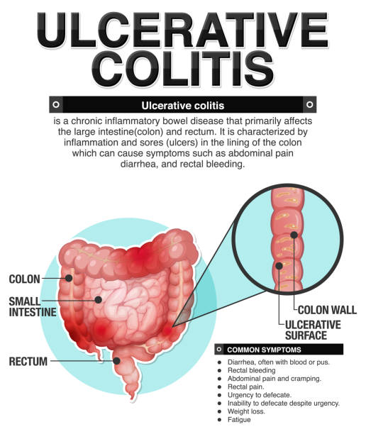 image show ulcerative colitis, and homeopathic treatment at Santosh Homoeo Hall and Clinic