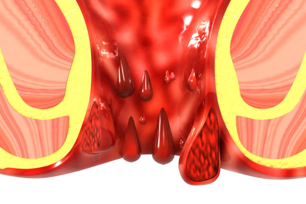 Bleeding Piles treatment at Santosh Homoeo Hall and clinic