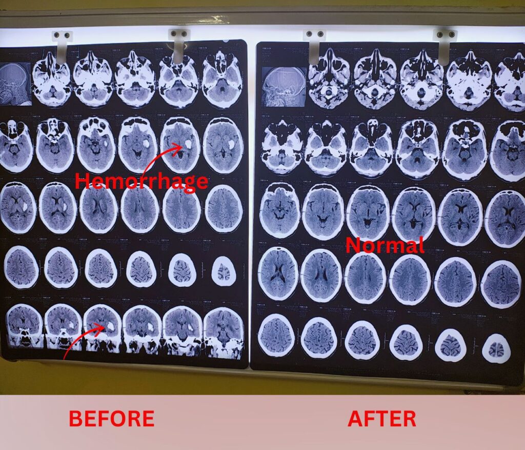 Brain hemorrhage patient take homeopathic treatment at Santosh Homoeo Hall and clinic