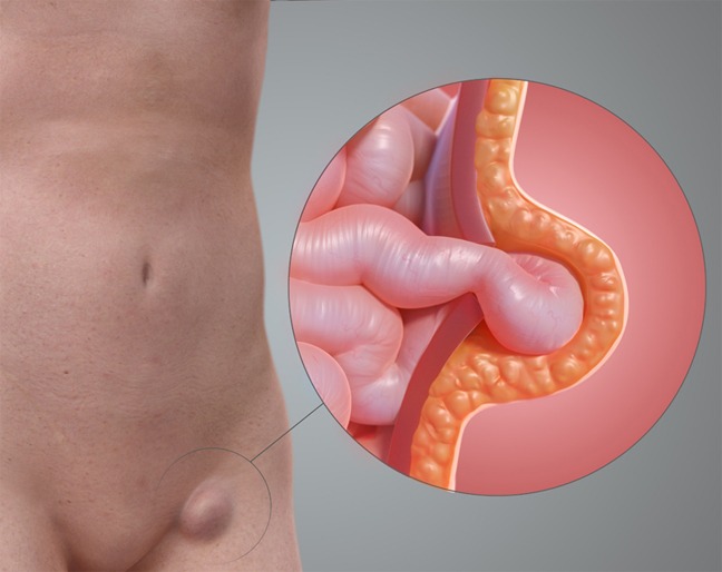 Image of femoral hernia, and take homeopathic treatment at Santosh Homoeo Hall and clinic
