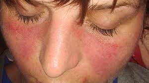 A lady suffer from SLE and take homeopathic treatment at Santosh homoeo Hall and Clinic
