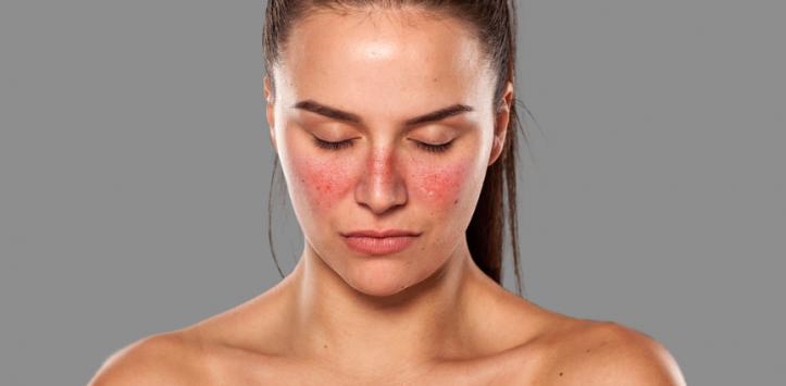 A woman suffer from SLE and take homeopathic treatment at Santosh Homoeo Hall and Clinic