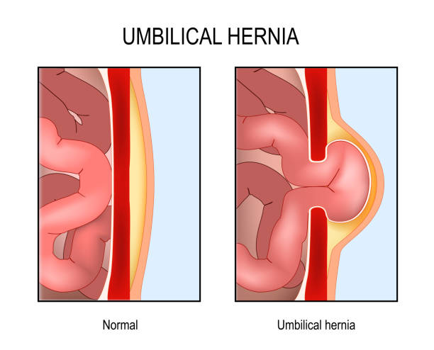 umblical hernia and take homo Pathik at Santosh homeo hall and clinic