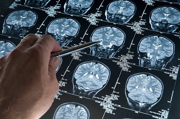 Image of Alzheimer disease and take homeopathic treatment at Santosh Homoeo Hall and Clinic