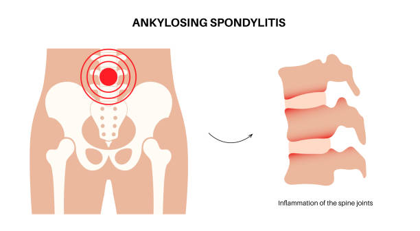 An image show ankylosing spondylitis and take homeopathic treatment at Santosh Homoeo Hall and clinic