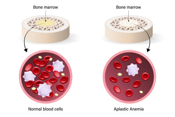 A picture show aplastic anemia and take homeopathic treatment at Santosh Homoeo Hall and Clinic