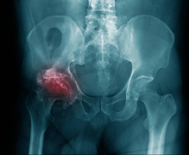 A picture of avascular necrosis and take homeopathic treatment at Santosh Homoeo Hall and clinic