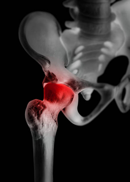 A picture of avascular necrosis and take homeopathic treatment at Santosh Homoeo Hall and clinic