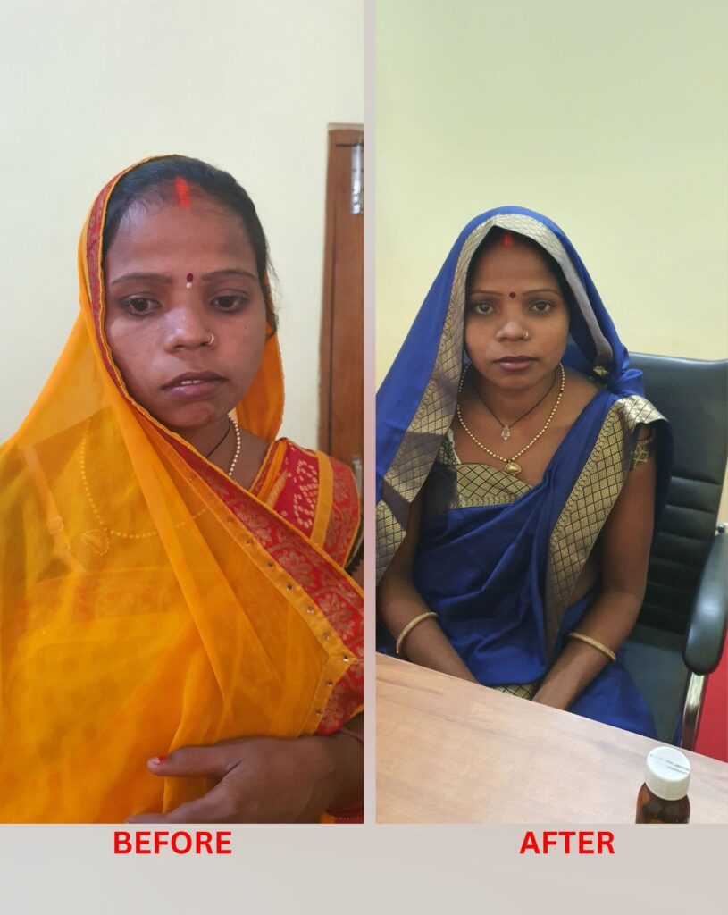 Bell's palsy homeopathic treatment at Santosh Homoeo Hall and clinic
