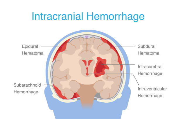 Image of brain, hemorrhage, and take homeopathic treatment at Santosh homeo hall and clinic