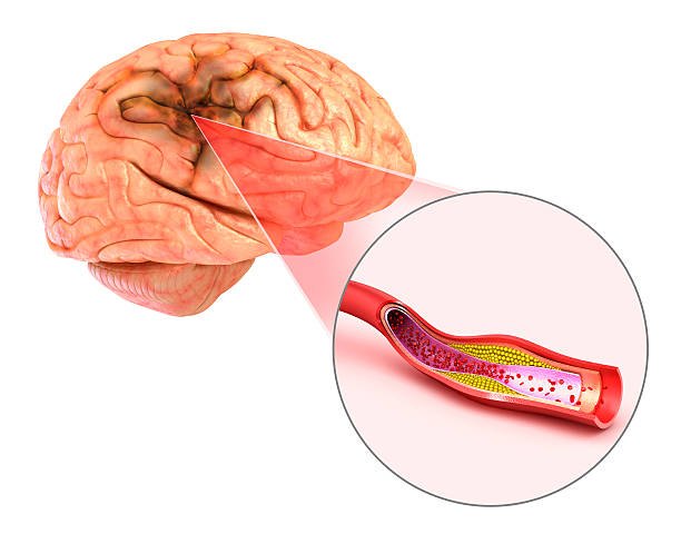 A picture of brain hemorrhage, and take homeopathic treatment at Santosh Homoeo Hall and Clinic