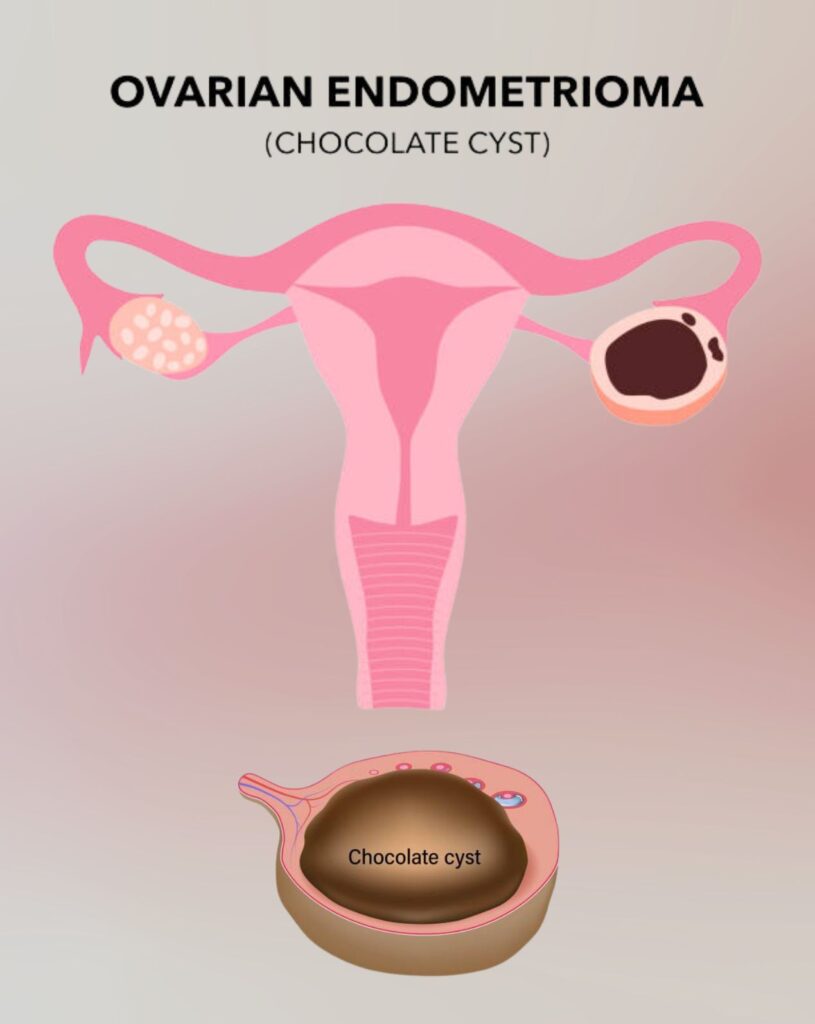 Image show chocolate cyst and take homeopathic treatment at Santosh Homoeo Hall and clinic