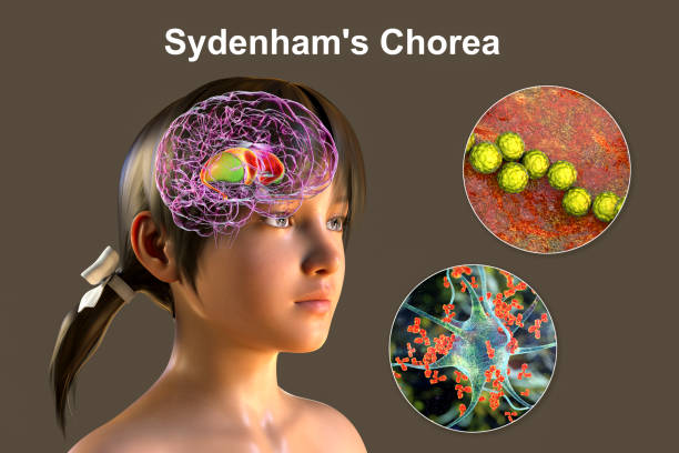 Image of chorea and take homeopathic treatment at Santosh Homoeo Hall and Clinic