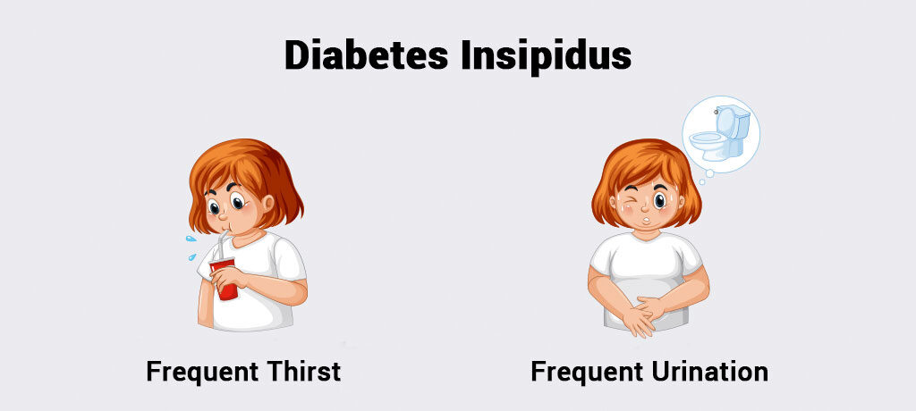 A picture show symptom of diabetes incipidus, and take treatment at Santosh Homoeo Hall and Clinic