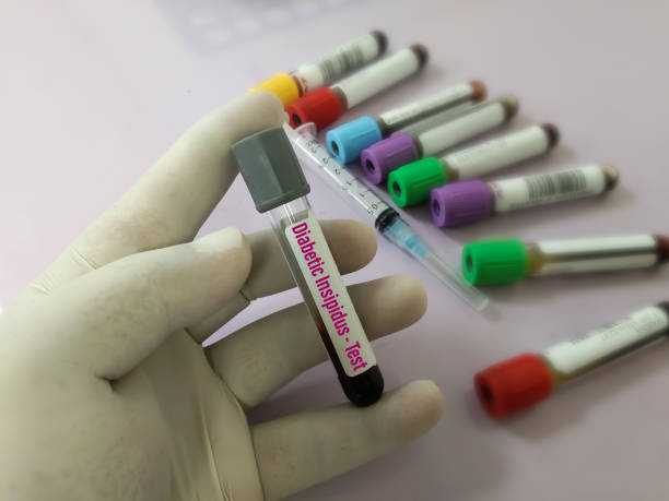 A blood test of diabetic, incipidus and take homeopathic treatment at Santosh Homoeo Hall and clinic