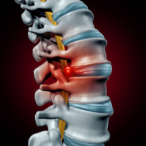 A picture of disc bulge and take homeopathic treatment at Santosh Homoeo Hall and clinic