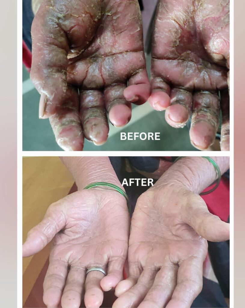 Eczema homeopathic treatment at Santosh Homoeo Hall and Clinic