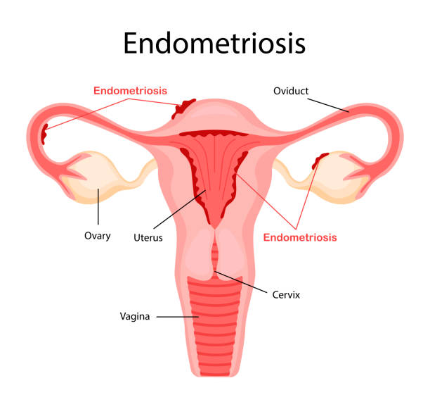A picture of endometriosis and take homeopathic treatment at Santosh Homoeo Hall and clinic