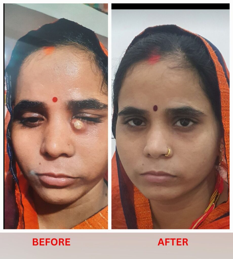 eye abscess homeopathic treatment at Santosh Homoeo Hall and clinic