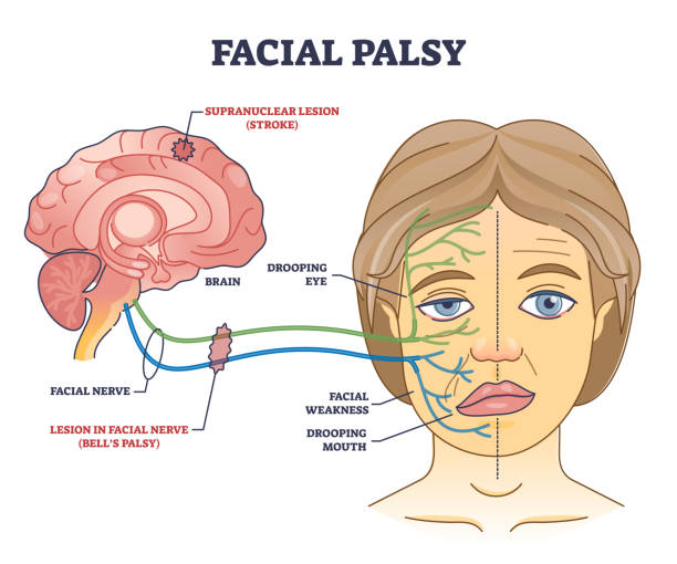 Image of facial palsy and treatment at Santosh Homoeo Hall and Clinic