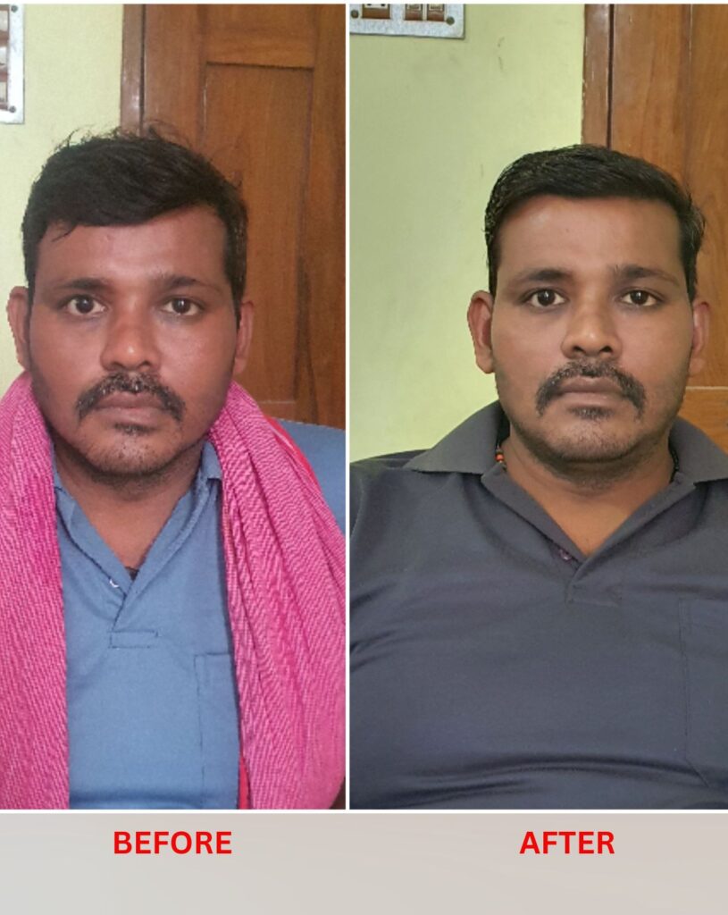 Facial paralysis homeopathic treatment at Santosh Homoeo Hall and clinic
