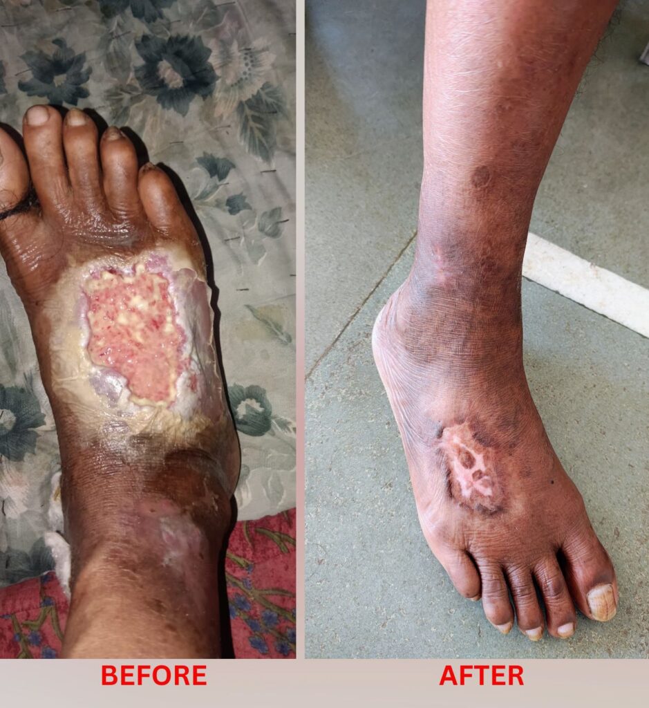 Gangrene homeopathic treatment at Santosh show me your Holland Clinic