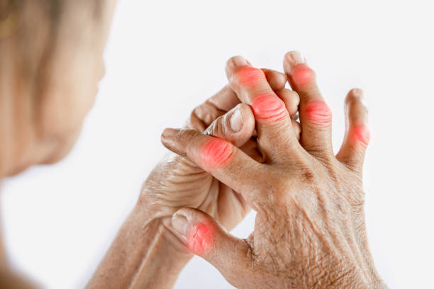 A lady suffer from gout, pain and take homeopathic treatment at Santosh homoeo Hall and Clinic