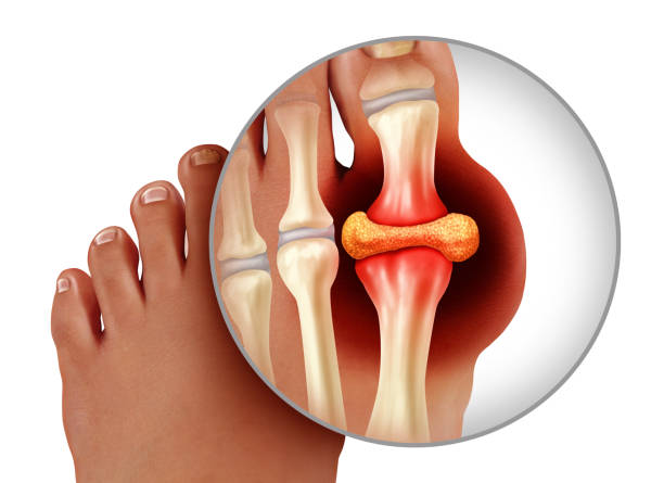 Image of gout, pain, and take homeopathic treatment at Santosh homoeo Hall and Clinic