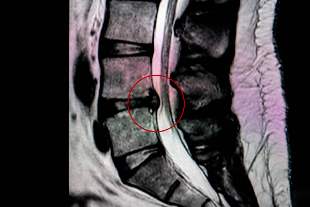 A picture show herniated disc and take homeopathic treatment at Santosh Homoeo Hall and clinic
