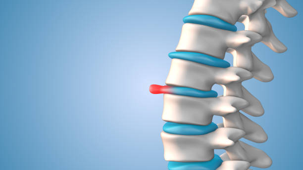 A picture of herniated disc and take homeopathic treatment at Santosh Homoeo Hall and Clinic