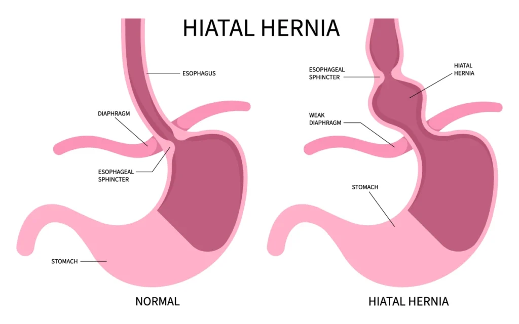 Image of hiatal hernia and take homeopathic treatment at Santosh Homoeo Hall and Clinic
