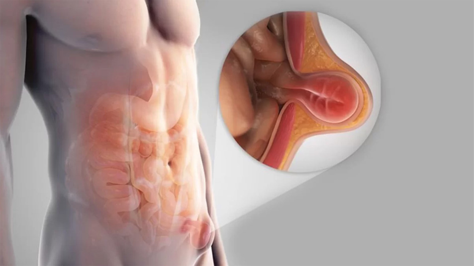 Image of inguinal hernia and take homeopathic treatment at Santosh homeo and clinic