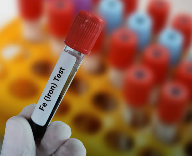 A picture of test tube with iron deficiency anemia, and take homeopathic treatment at Santosh homeo hall and Clinic