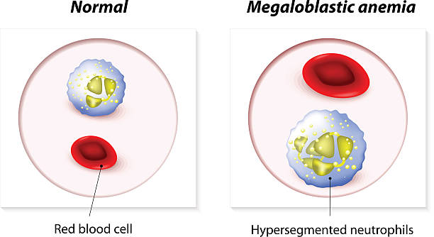 A picture of megaloblastic anemia, and take homeopathic treatment at Santosh Homoeo Hall and Clinic
