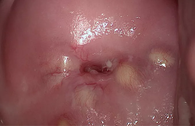 A picture of nabothian cyst in cervix and take homeopathic treatment at Santosh homoeo Hall and Clinic