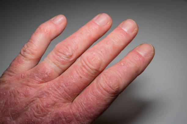 Picture of hand suffer from psoriatic arthritis and take homeopathic treatment at Santosh, homeo Hall and Clinic