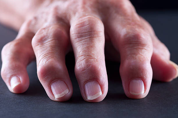 A picture of hand suffer from rheumatoid arthritis and take homeopathic treatment at Santosh Homoeo Hall and clinic