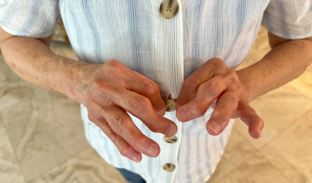 Picture of old man suffer from rheumatoid arthritis and take homeopathic treatment at Santosh Homoeo Hall and Clinic