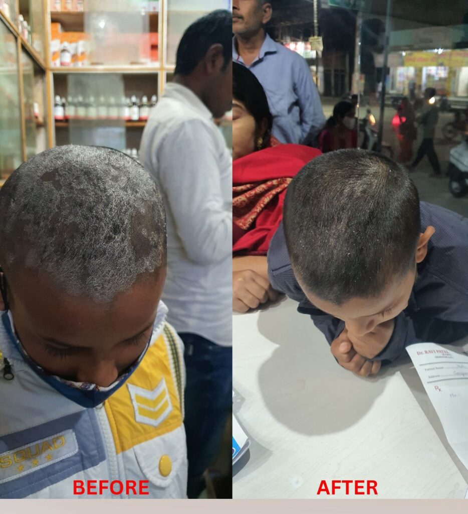 Scalp psoriasis homeopathic treatment at Santosh Homoeo Hall and clinic