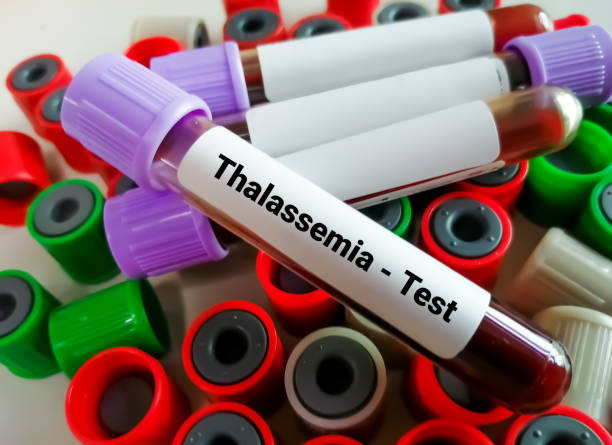 A picture of thalassemia blood test and take homeopathic treatment at Santosh show me your Holland Clinic