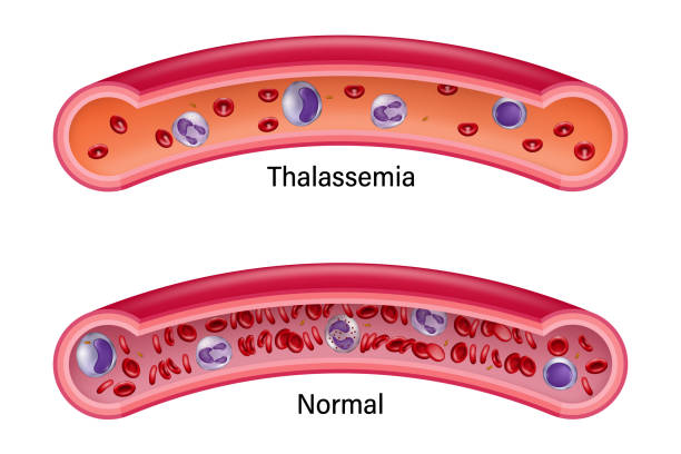 A picture of thalassemia and take homeopathic treatment at Santosh Homoeo Hall and clinic
