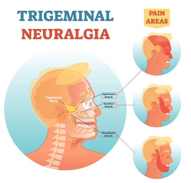 Image of trigeminal neuralgia and take homeopathic treatment at Santosh Homoeo Hall and Clinic