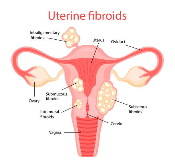 A picture of Uterine fibroid and take homeopathic treatment at Santosh Homoeo Hall and Clinic