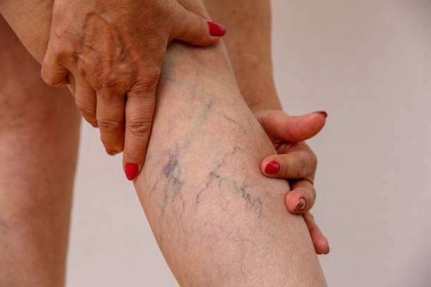 A person suffer from varicose vein and take homeopathic treatment at Santosh homoeo Hall and Clinic
