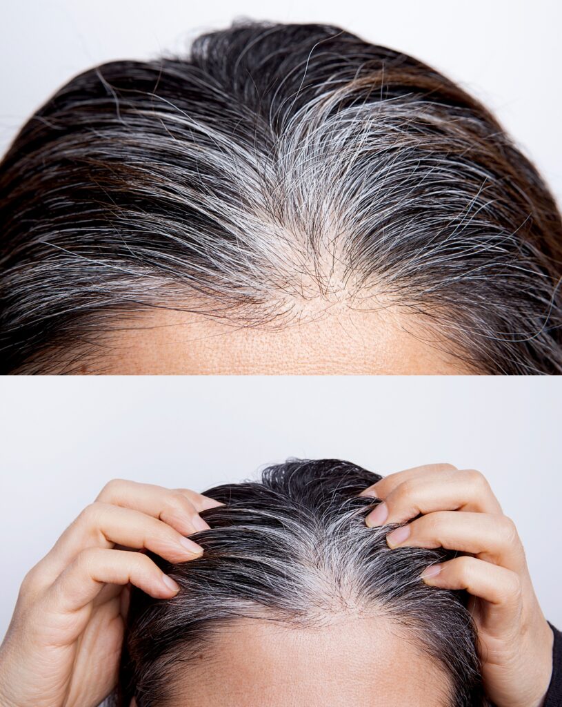 White hair, Patient at Santosh Homoeo Hall and clinic